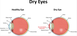 Dry Eye? Choosing Between Eye Drop Medications Or Punctal Plugs? Read This